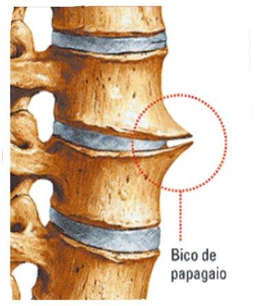 Bico de papagaio ou osteofitose