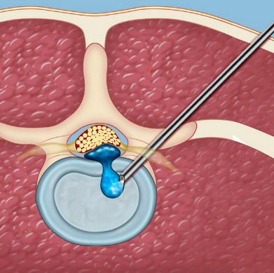 Cirurgia Endoscópica da Coluna