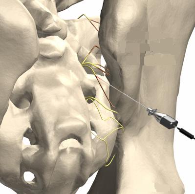 Ilustração mostrando a emergência dos nervos sacrais posteriores e a cânula de Rizotomia