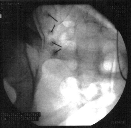 Imagem radioscópica exemplificando os forames de S1 e S2 com as cânulas de radiofrequência já posicionadas na emergência dos nervos sacrais de S1 e S2 para procedimento de rizotomia por radiofrequência