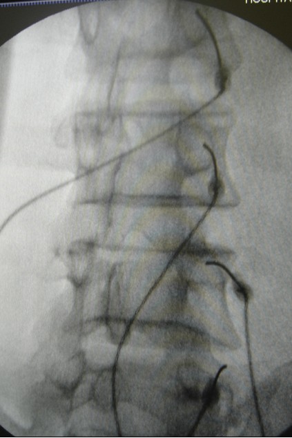 Mostra-se uma imagem de Raio-X com a correta colocação das agulhas na saída do ramo medial que deve ser confirmada antes de iniciar a lesão térmica