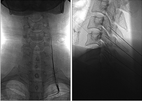 Na coluna cervical, o procedimento é parecido, mudando apenas as ponteiras, que são menores. Ao lado, exemplo de rizotomia cervical pelo Raio-X