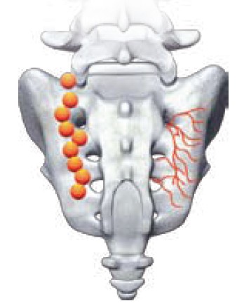 Exemplo dos pontos a serem denervados e anatomia da emergência dos nervos sacrais posteriores de S1 a S3
