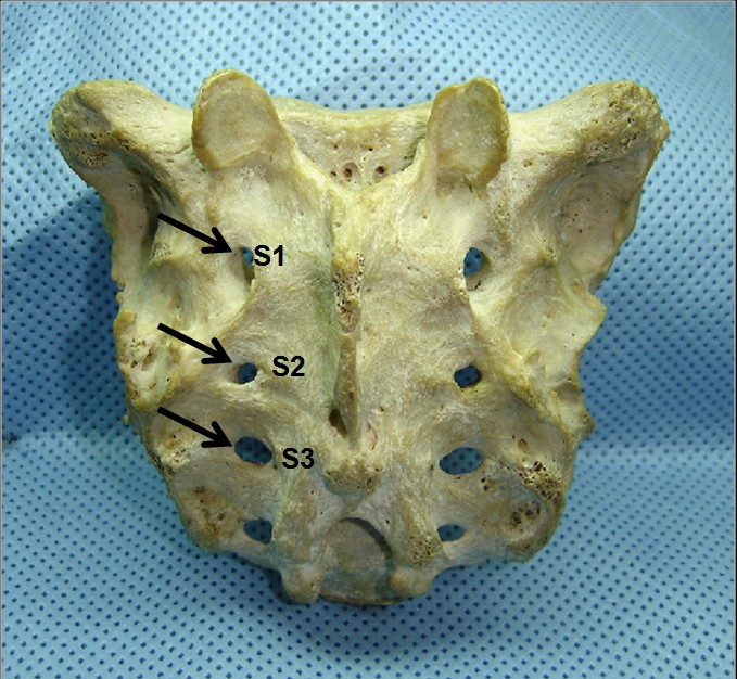Modelo anatômico exemplificando os forames de S1 a S3, onde emergem os nervos responsáveis pela sensibilidade dolorosa da articulação sacro-ilíaca
