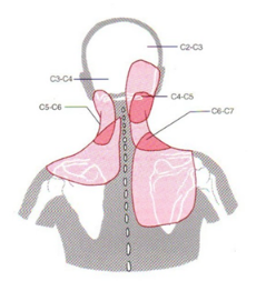 Discopatia Degenerativa Cervical