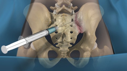 Infiltração intra-articular