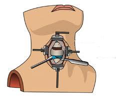 Na Artrodese cervical ou cirurgia convencional de hérnia de disco cervical, o acesso para a coluna, quando o objetivo é a retirada do disco, é por via anterior. Este acesso é simples, seguro e indolor, pois abordamos os planos existentes entre os músculos e a traquéia.