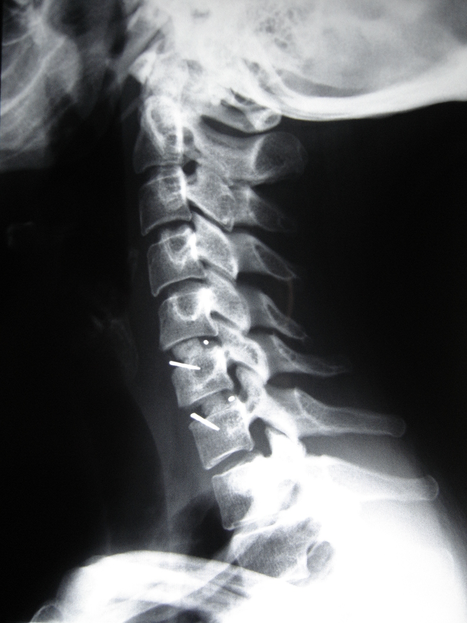 Ao lado, imagem de raio-x evidenciando Artrodese cervical de dois níveis com colocação de espaçadores 'cages', com enxerto ósseo.
