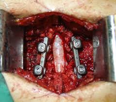 Intraoperatório de artrodese lombar convencional aberta