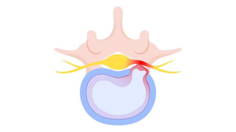 compressão nervosa provocada por hérnia de disco