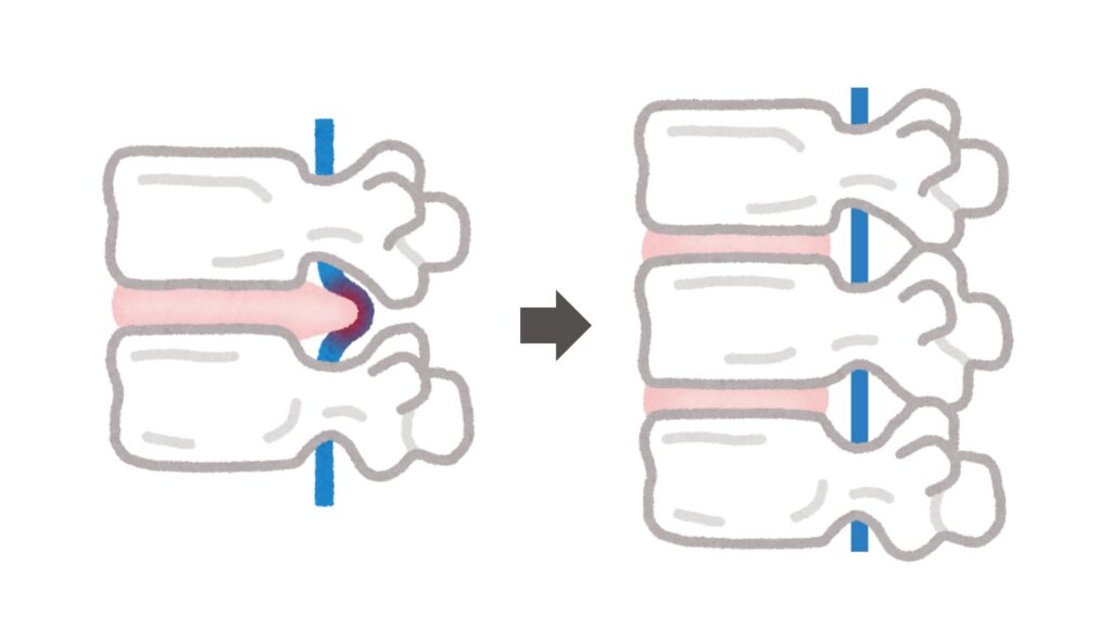 nervo comprido à esquerda e nervo descomprimido à direita