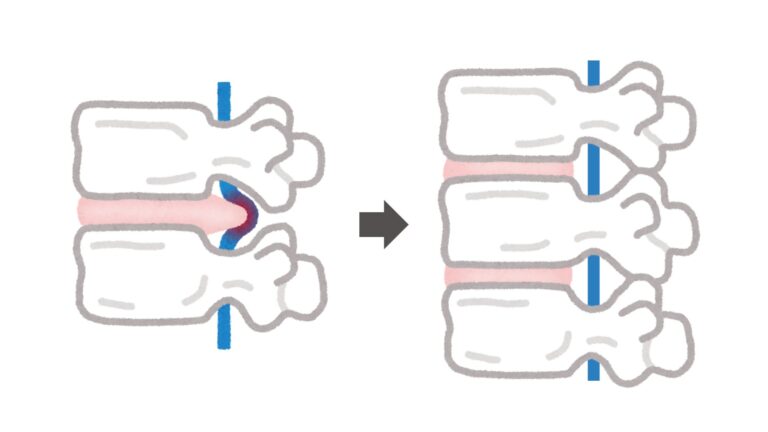 nervo comprido à esquerda e nervo descomprimido à direita