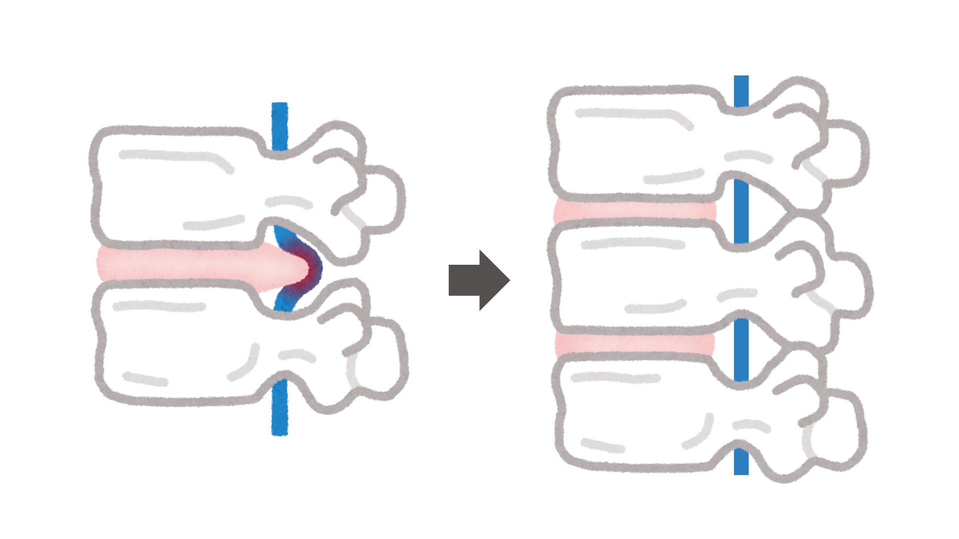 descompressão nervosa img nervo comprido à esquerda e nervo descomprimido à direita