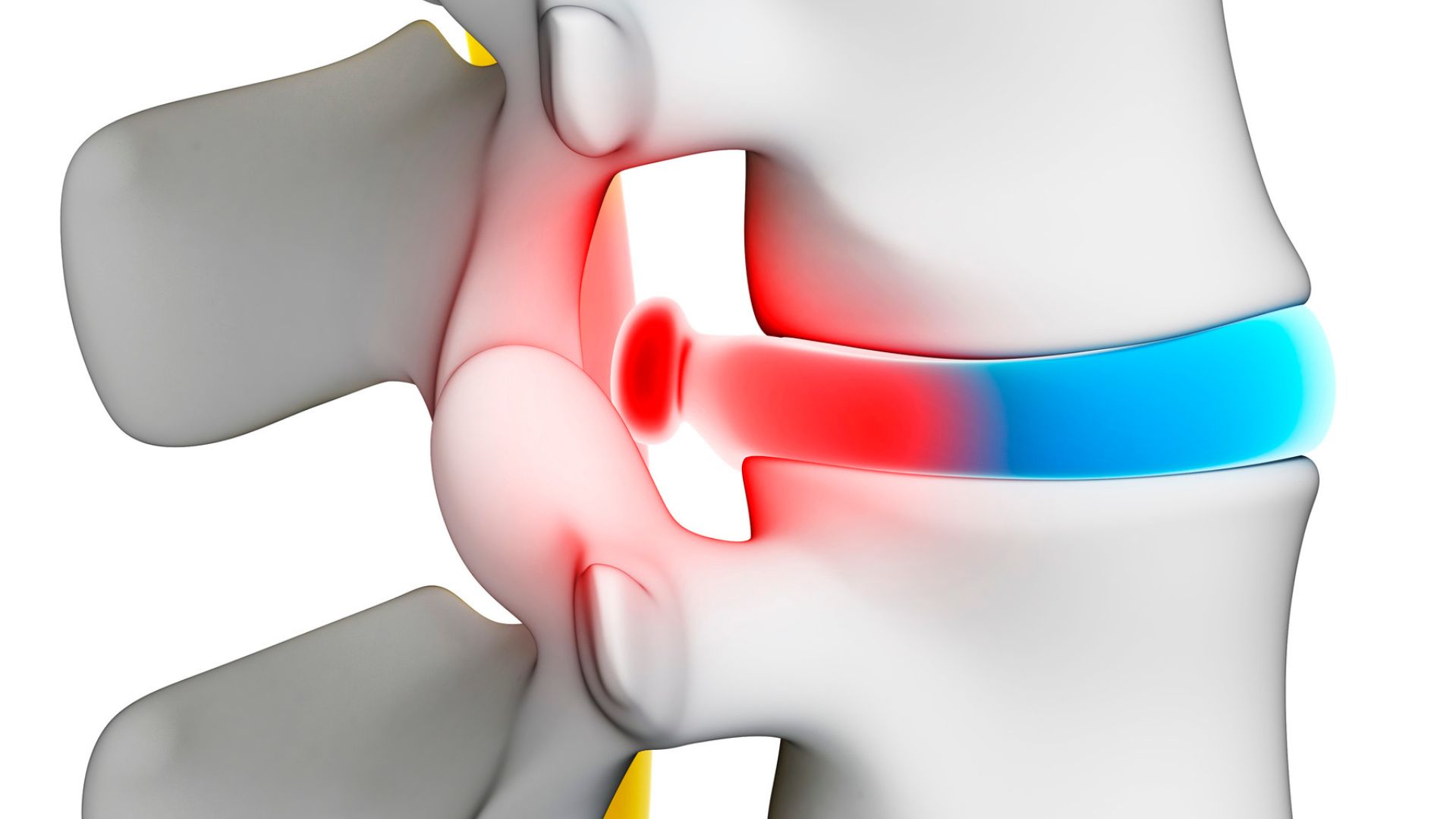 laminectomia img compressão de nervo da coluna vertebral