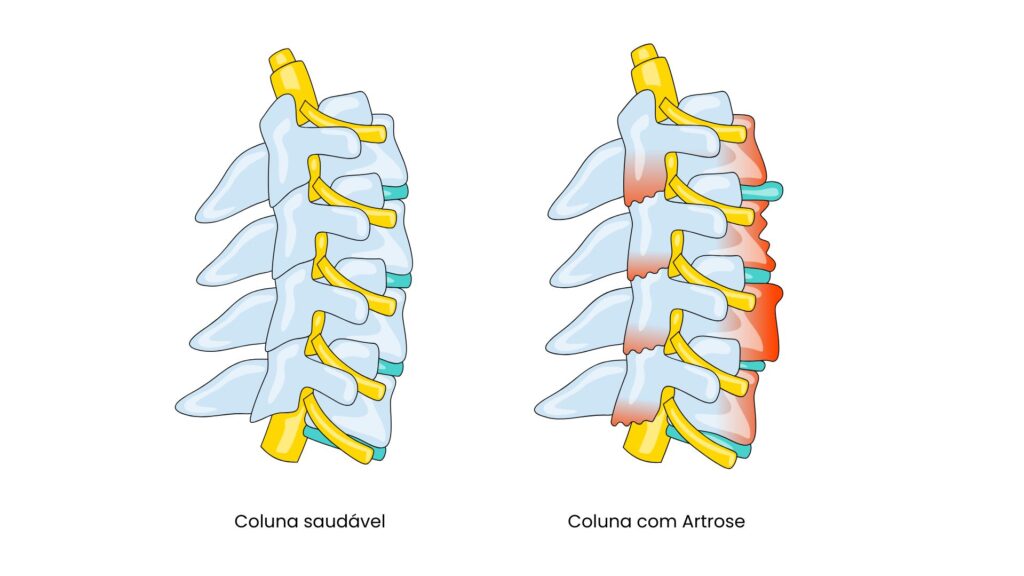 Coluna saudável ao lado de coluna com Artrose
