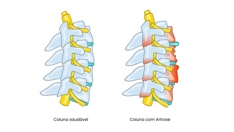 Coluna saudável ao lado de coluna com Artrose