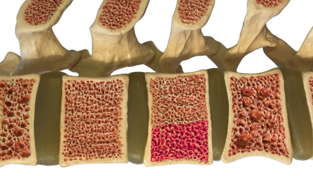 corte seccional na coluna vertebral com hemangioma
