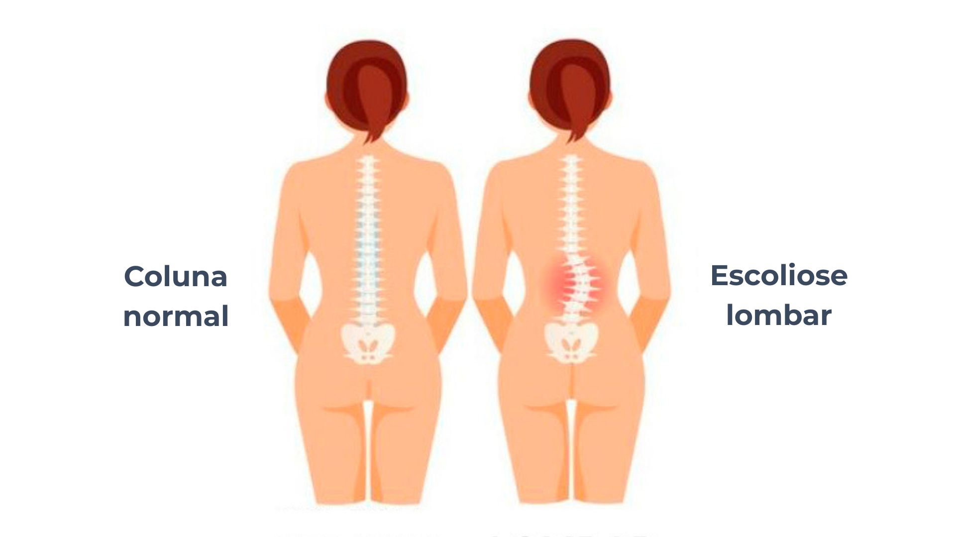 pessoa com escoliose lombar ao lado de outra com coluna normal