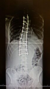 radiografia de coluna de adolescente pós cirurgia de Escoliose