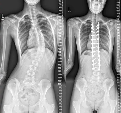raio x de antes e depois de cirurgia de escoliose idiopática