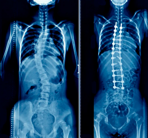 raio x de antes e depois de cirurgia de escoliose idiopática