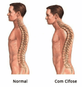 perfil lateral de dois homens, um com a coluna normal e outro com coluna com cifose