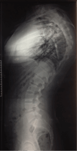 radiografia lateral de coluna com cifose