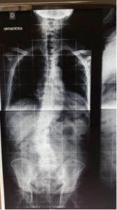 radiografia escoliose degenerativa compensada no plano coronal