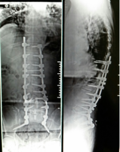 radiografia de coluna que passou por cirurgia escoliose