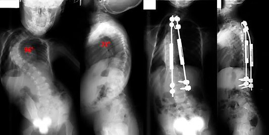 raio x antes e depois de cirurgia de escoliose idiopática growing rods